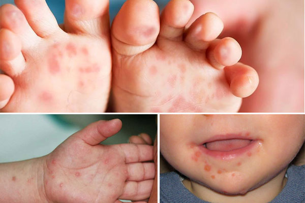 Tay chân miệng là bệnh phổ biến ở trẻ nhỏ dưới 5 tuổi